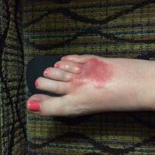 Yucky Foot